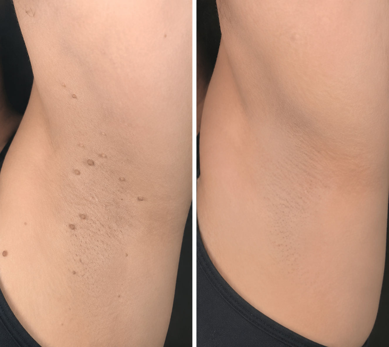 ✨✨✨PURESHADE® 2 az 1-ben mikrotűs és hidrokolloid tapasz🍀 | Kiálló anyajegyek, aknék, lapos szemölcsök és bőrnövedékek eltávolítására | Segít csökkenteni a ráncokat, hegeket és bőrhibákat | Láthatatlan tapasz az arcra és testre