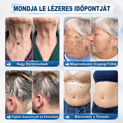 Hivatalos Márkabolt | 🚢🚢 Hiskin® 7 napos Szemölcseltávolító Roll-on Ápoló Folyadék (Fájdalommentes rollerball technológia, hegek nélkül) 🐬