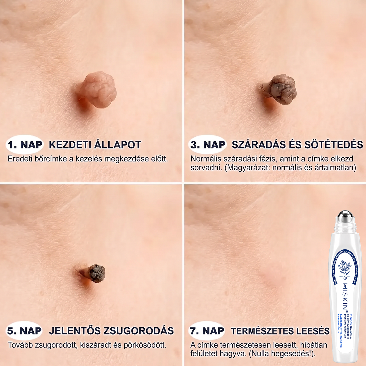 Hivatalos Márkabolt | 🚢🚢 Hiskin® 7 napos Szemölcseltávolító Roll-on Ápoló Folyadék (Fájdalommentes rollerball technológia, hegek nélkül) 🐬