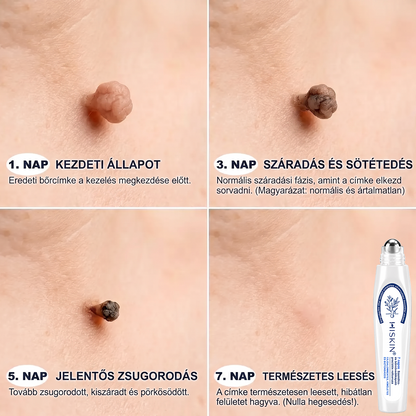 Hivatalos Márkabolt | 🚢🚢 Hiskin® 7 napos Szemölcseltávolító Roll-on Ápoló Folyadék (Fájdalommentes rollerball technológia, hegek nélkül) 🐬