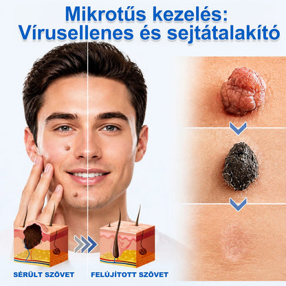 ✨✨✨PURESHADE® 2 az 1-ben mikrotűs és hidrokolloid tapasz🍀 | Kiálló anyajegyek, aknék, lapos szemölcsök és bőrnövedékek eltávolítására | Segít csökkenteni a ráncokat, hegeket és bőrhibákat | Láthatatlan tapasz az arcra és testre